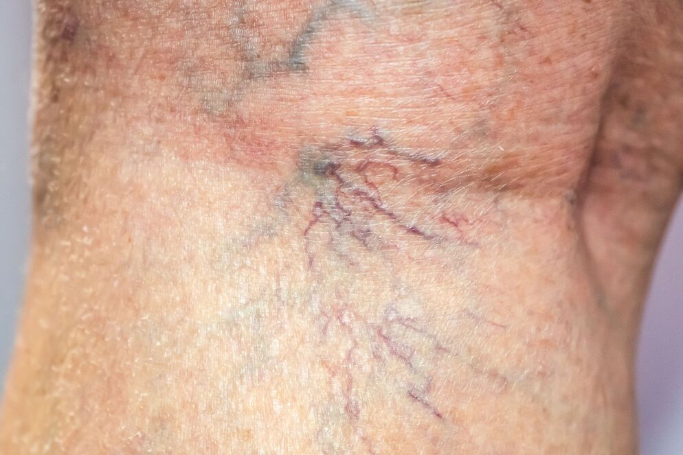 Varicose veins on the body