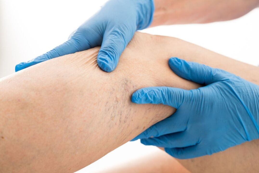Clinical Card Varicose Disease