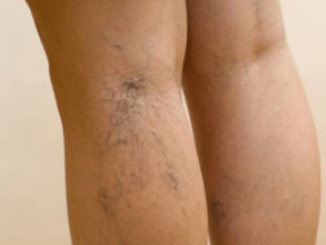 The second phase of varicose veins