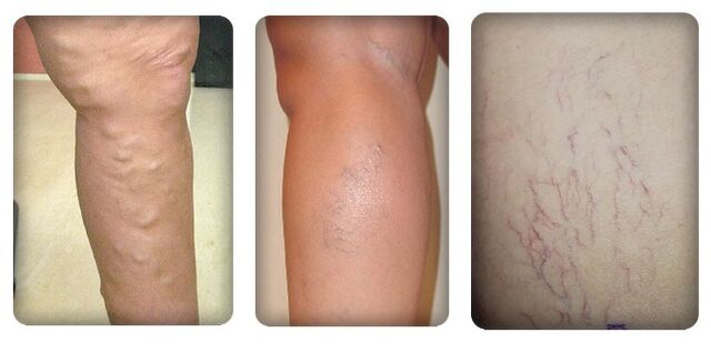Varicose vein stages