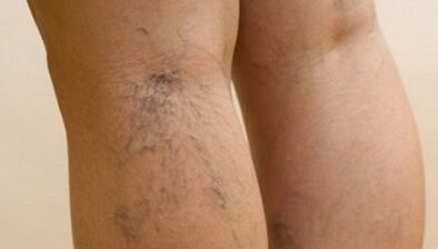 Causes of varicose veins