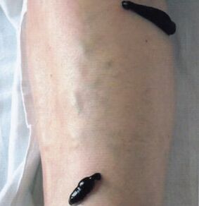 Hydrudocarapy as a method of treatment of varicose veins