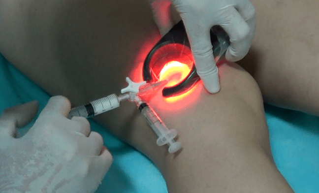 Sclerotherapy is an effective method of treating varicose veins on the legs