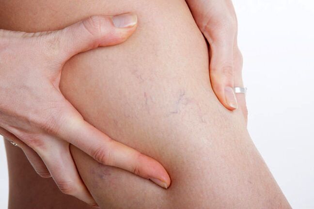 The first appearance of varicose veins on the leg